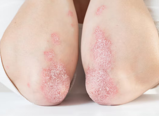 Psoriasis Treatments