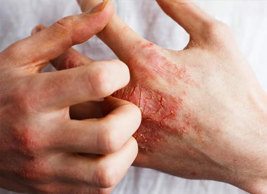 Eczema/Atopic Dermatitis Treatments.