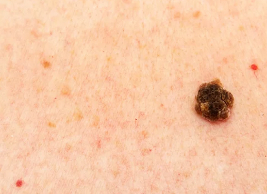 Seborrheic Keratosis