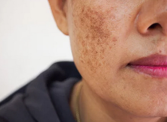 Melasma Treatments