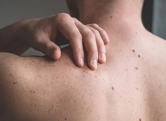 Mole Treatments