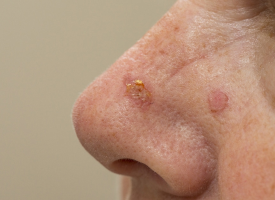 Actinic Keratosis Treatments.