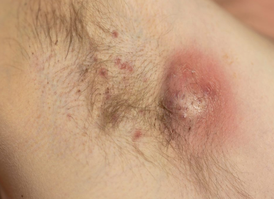 Hidradenitis Suppurativa Treatments
