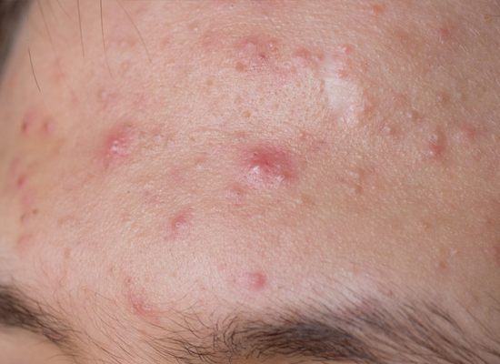 Acne Treatments