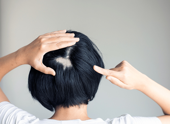 Alopecia Areata Treatments.